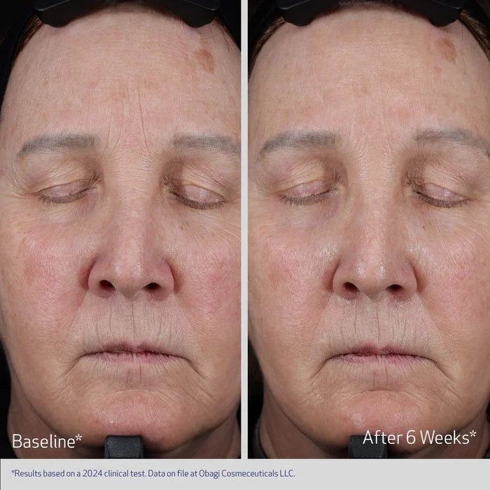 ELASTIDERM LIFT UP & SCULPT FACIAL MOISTURIZER BEFORE AND AFTER 6 WEEKS | VISIBLE IMPROVEMENT IN FOREHEAD LINES AND SAGGING SKIN | PARTICIPANT 1